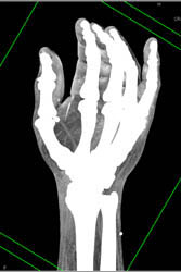 Cellulitis - CTisus CT Scan