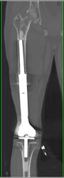 Total Knee in Good Position - CTisus CT Scan