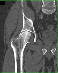 Avascular Necrosis (AVN) Hip - CTisus CT Scan