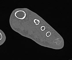 Fracture and Second Metacarpal - CTisus CT Scan