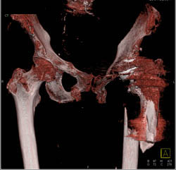 3D of Failed Total Hip Replacement (THR) With Proximal Femur Fractures - CTisus CT Scan