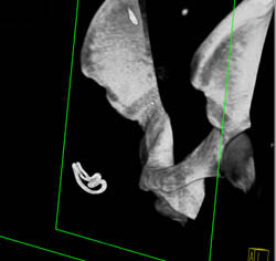 Foreign Body in Right Inguinal Zone- Sponge - CTisus CT Scan