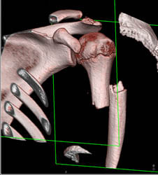 Humerus Fracture - CTisus CT Scan