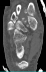 Lesfranc Fracture/dislocation - CTisus CT Scan