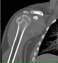 Humerus Fracture S/P Dislocation - CTisus CT Scan