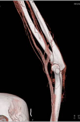 Abscess Around Vessels - CTisus CT Scan