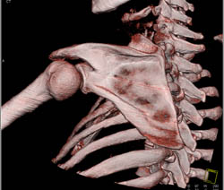 Deformity of Shoulder Joint With Deformed Humerus - CTisus CT Scan