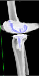 Total Knee Replacement (TKR) Without Abscess - CTisus CT Scan