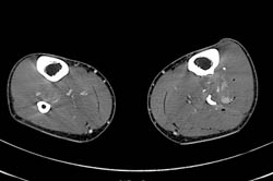 Comminuted Fibular Fracture With Bleed - CTisus CT Scan