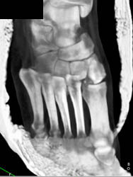 Lisfrancs Fracture - CTisus CT Scan