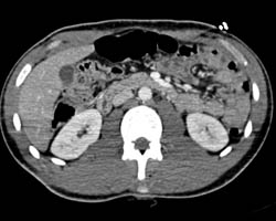 Bleed in Left Gluteal Muscle - CTisus CT Scan