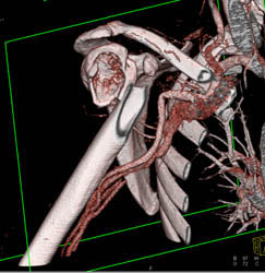 Humerus Fracture With Normal CTA - CTisus CT Scan