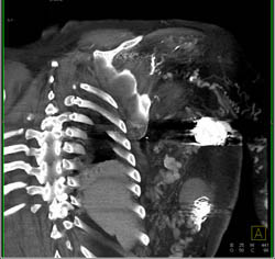 Post Embolization of Arteriovenous Malformation (AVM) - CTisus CT Scan