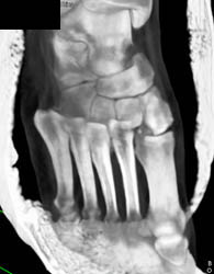 Lisfranc Fracture- Dislocation Shown Nicely in Range of 3D Images - CTisus CT Scan