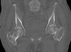 Impacted Fracture Left Femoral Neck - CTisus CT Scan