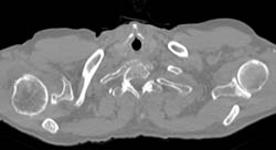 Cystic Changes Right Shoulder Due to Degenerative Joint Disease (DJD) - CTisus CT Scan