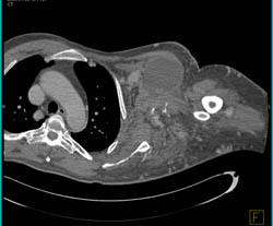 Embolized Arteriovenous Malformation (AVM) in Axilla But Still Present - CTisus CT Scan