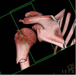 Humerus Fracture - CTisus CT Scan