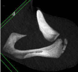 Humerus Fracture - CTisus CT Scan