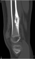 Osteoid Osteoma With Periosteal Reaction and Nidus - CTisus CT Scan