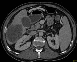 Metastases to Paraspinal Muscles - CTisus CT Scan