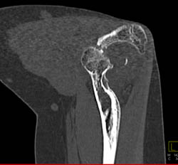 Trauma to Elbow With Humerus Fracture - CTisus CT Scan