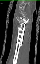 Nonunion Fracture With Hardware - CTisus CT Scan