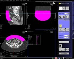 Volume for DIEP Flap Reconstruction - CTisus CT Scan