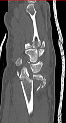 Fracture/dislocation Radius/ulna - CTisus CT Scan