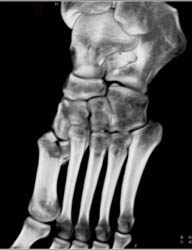 Lisfranc Fracture and Dislocation - CTisus CT Scan