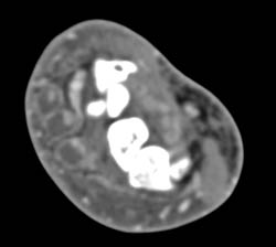 Abscess Along Tendons in Wrist - CTisus CT Scan