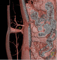 DIEP Flap Planning - CTisus CT Scan