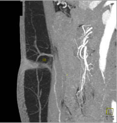 DIEP Flap Planning - CTisus CT Scan