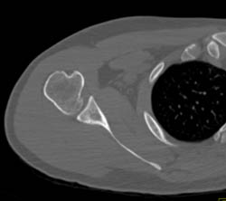 Intact Shoulder Joint - CTisus CT Scan