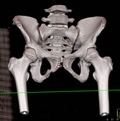 Inferior Pubic Ramus Fracture - CTisus CT Scan