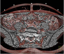 DIEP Flap Planning - CTisus CT Scan