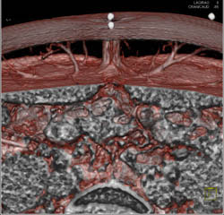 DIEP Flap Planning - CTisus CT Scan