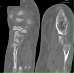 Tarsal Coalition - CTisus CT Scan