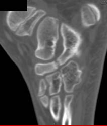 Tarsal Coalition - CTisus CT Scan