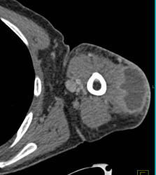 Abscess in Upper Arm With Cellulitis - Musculoskeletal Case Studies ...