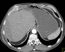 Metastatic Lesion to Rib With Radiation Changes in the Liver Seen as Well - CTisus CT Scan