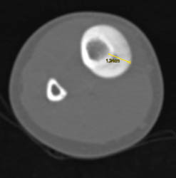 Osteoid Osteoma - CTisus CT Scan