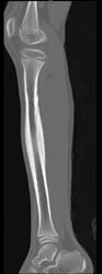 Osteoid Osteoma - CTisus CT Scan