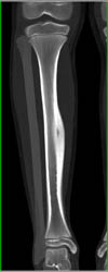 Osteoid Osteoma - CTisus CT Scan