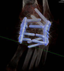 Fractured Screws in Repair Seen on 3D Only - CTisus CT Scan