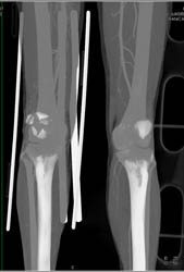 Fractured Patella - CTisus CT Scan