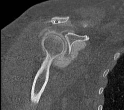 Rotator Cuff Tear - CTisus CT Scan