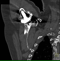 Total Shoulder Replacement With Degenerative Joint Disease (DJD) - CTisus CT Scan