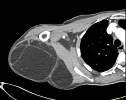 Lipoma With Septations and CTA Axillary Artery - CTisus CT Scan