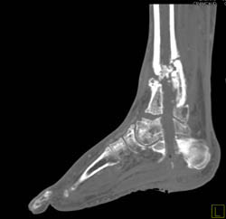 Non-union Following Removal of Rod - CTisus CT Scan